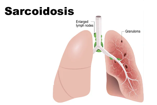 Sarcoidosis