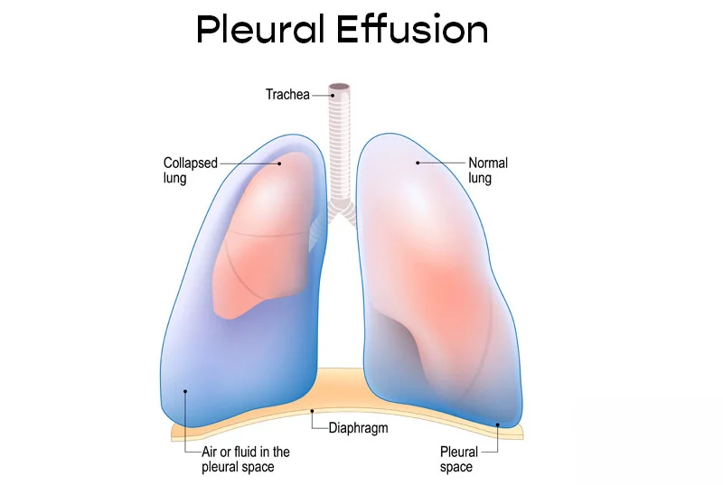 Pleural Effusion