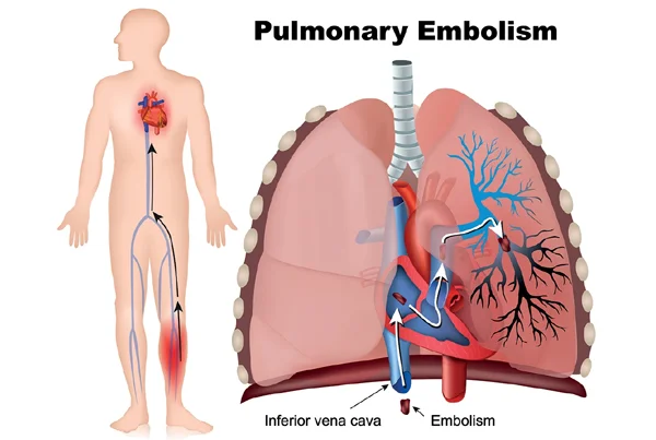 Pulmonary Embolism