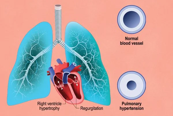 Pulmonary Hypertension